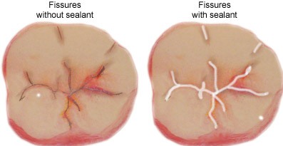 pit and fissure sealant